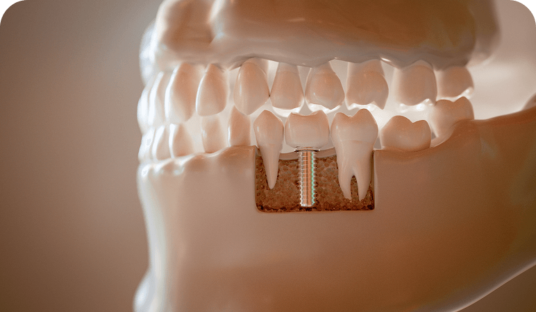 Close-up of tooth implant in jaw