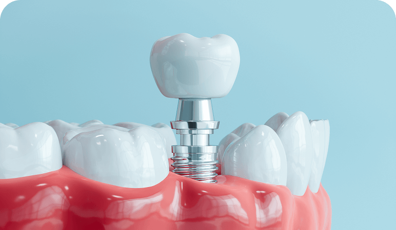 Tooth implant in gum model
