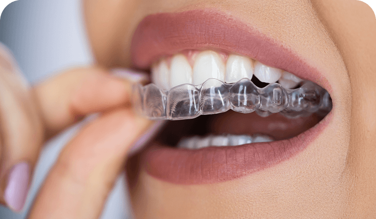 Clear dental aligner being applied